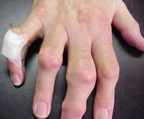 dedos com deformidades nas articulações causam dor