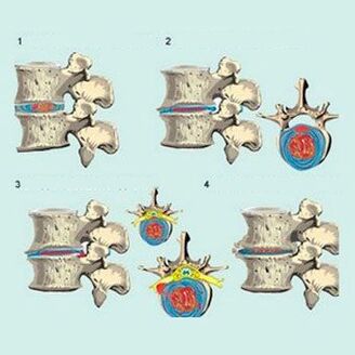 estágios de desenvolvimento da osteocondrose cervical