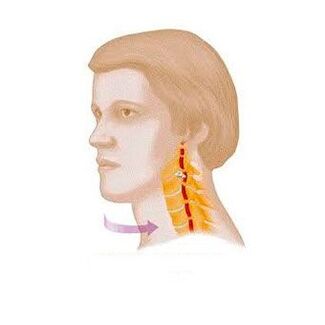 síndrome vertebral com osteocondrose cervical