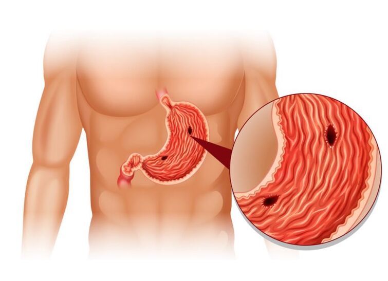 úlcera como a causa da dor sob a escápula esquerda atrás