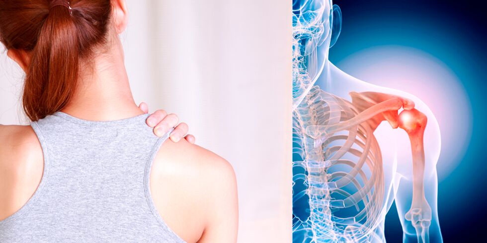 O desenvolvimento de osteoartrite do ombro leva gradualmente a dor constante