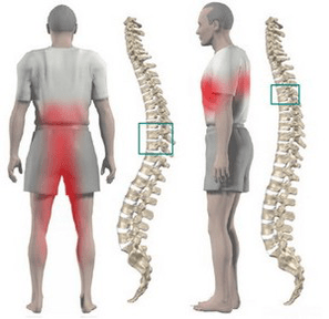 dor nas costas na osteocondrose torácica