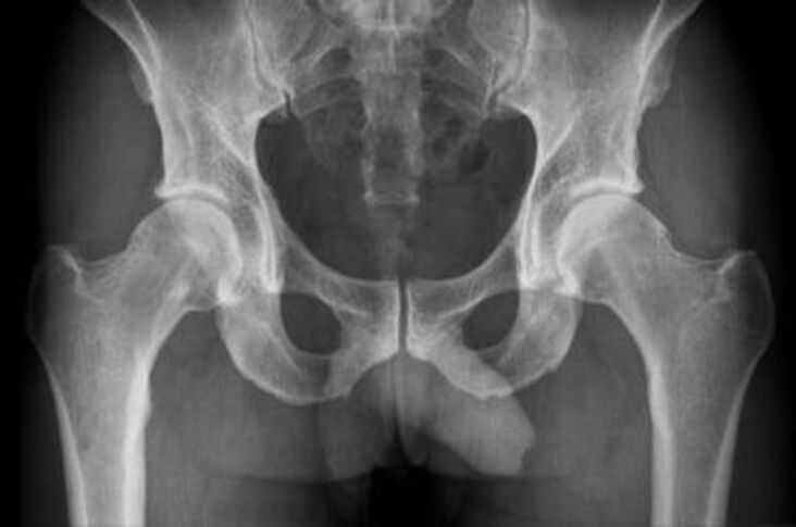 raio-x da articulação do quadril para dor