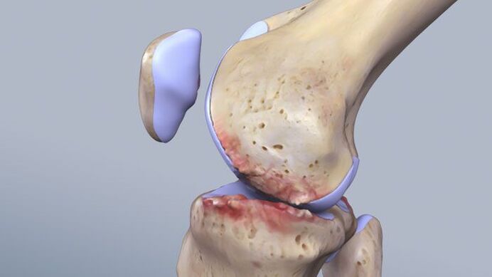 A estrutura da articulação do joelho afetada pela patologia