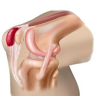 Uma das causas da dor na articulação do joelho é a bursite. 