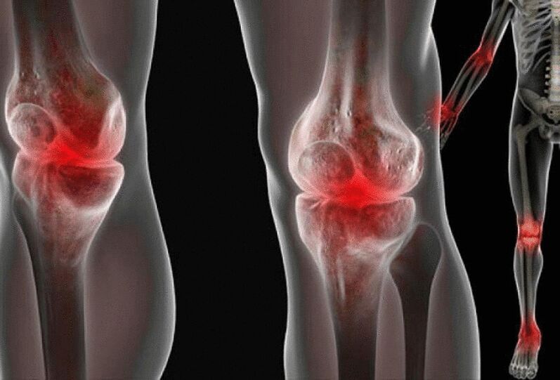 Dor nas articulações dos braços e pernas causada por várias doenças