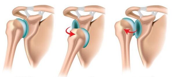 Luxação anterior e posterior da articulação do ombro, provocando o desenvolvimento de artrose