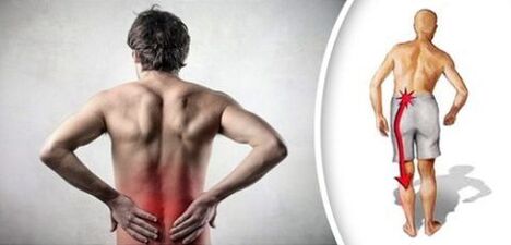 A síndrome da dor com osteocondrose lombar irradia para as pernas